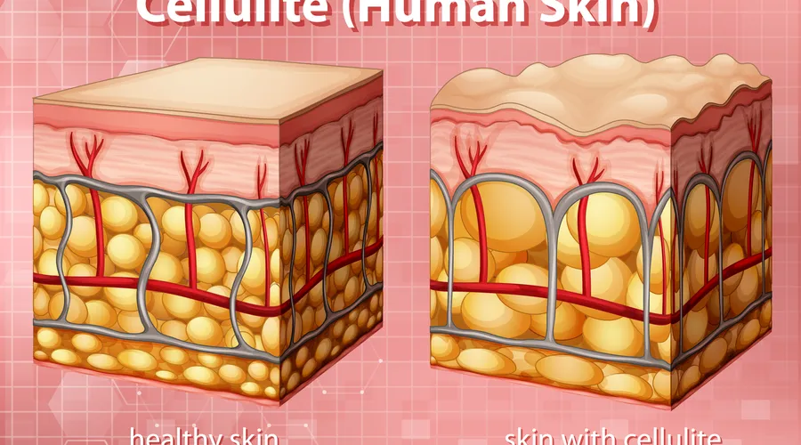 Selülit: Nedenleri ve Önleme Yöntemleri