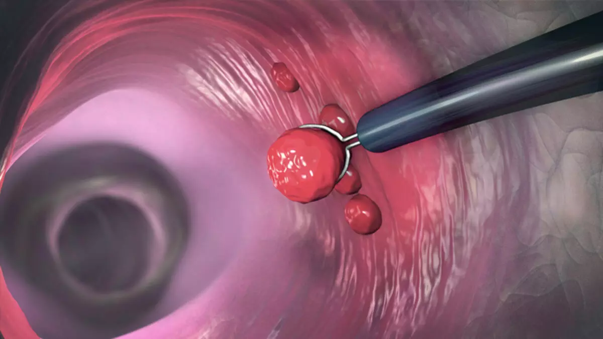 Bağırsak Polipleri: İhmal Edilmemeli ve Takip Edilmeli