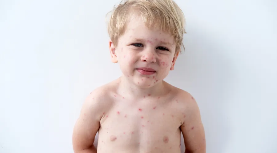 Su Çiçeği (Varicella): Çocukluk Hastalığı mı?