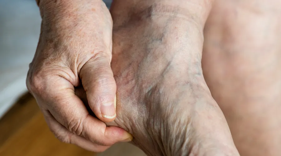 Topuk Dikeni: Nedenleri, Belirtileri ve Tedavi Seçenekleri