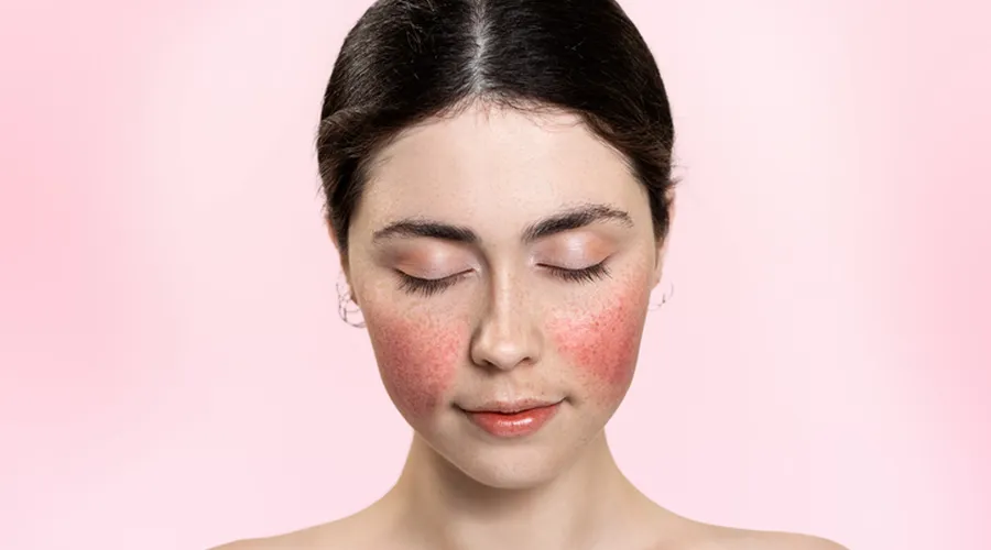 Rosacea: Yüzdeki Kızarıklık ve Enflamasyon