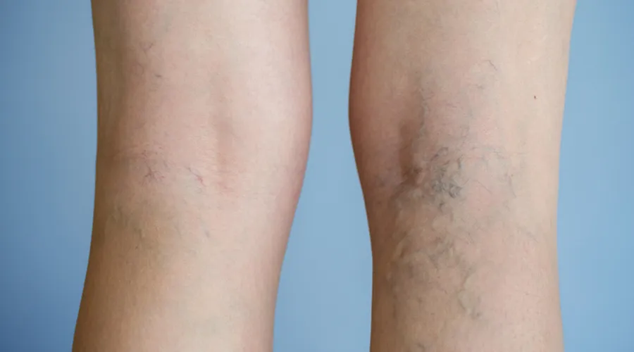 Varisli Damarlar: Nedenleri, Belirtileri ve Tedavi Yöntemleri