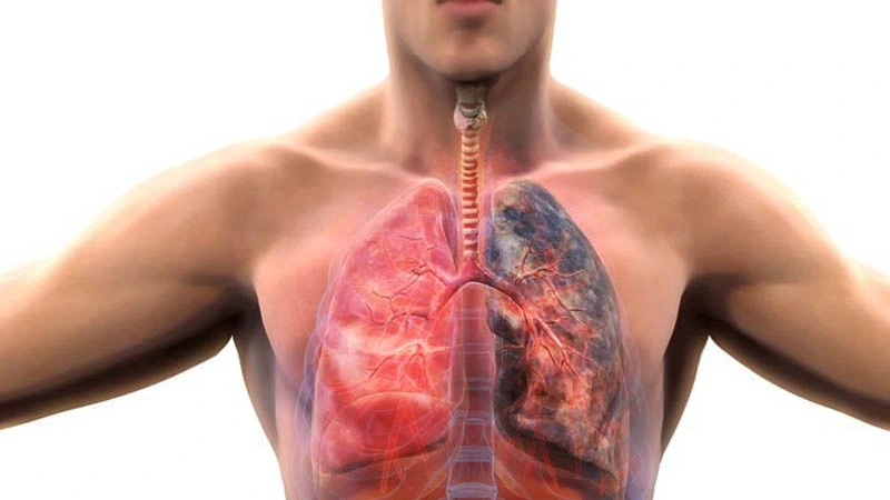 Hava Kirliliği KOAH Hastalığı Riskini Artırıyor!