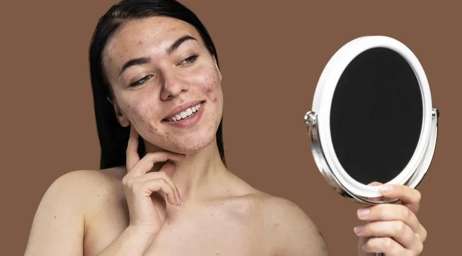 Akneye ve Sivilceye Karşı İlk Aşı İçin Klinik Denemeler Başladı