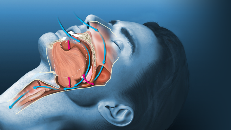 Obstrüktif Uyku Apnesi Orta Yaşlı Bireylerde Bilişsel Gerileme Üzerinde Önemli Etkilere Sahip Olabilir