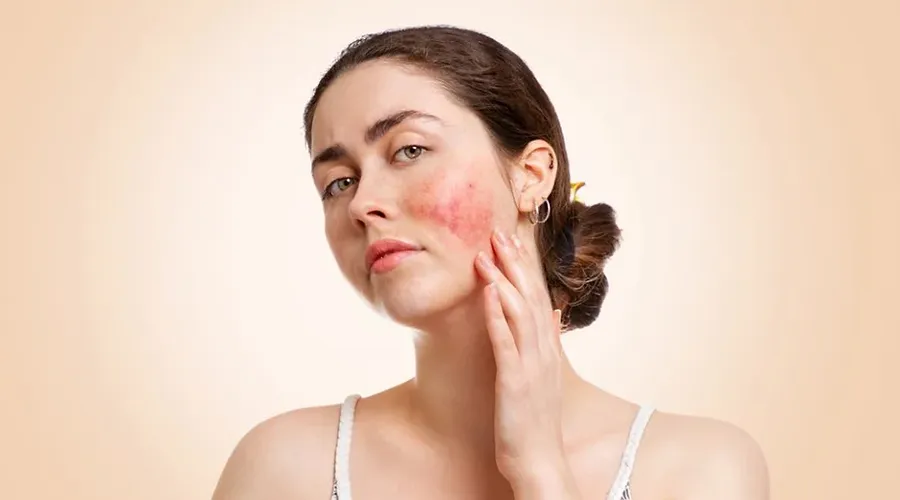 Lupus'un Gizemi Çözüldü Mü? Araştırmacılar, Bağışıklık Sistemindeki Dengesizliği Temel Neden Olarak Gösteriyor